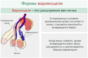 Варикоцеле 1 или 3 группа здоровья