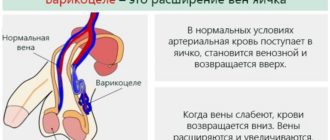 Варикоцеле 1 или 3 группа здоровья