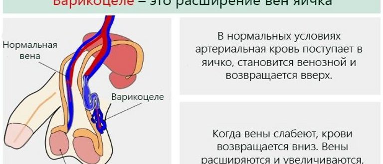 Варикоцеле 1 или 3 группа здоровья