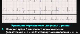 ЭКГ: ЭОС отклонено вправо, синусовый ритм, ЧСС=62
