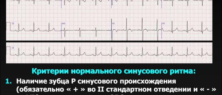 ЭКГ: ЭОС отклонено вправо, синусовый ритм, ЧСС=62