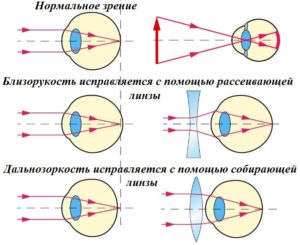 Можно ли при миопии носить линзы