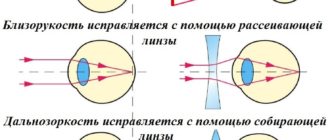 Можно ли при миопии носить линзы