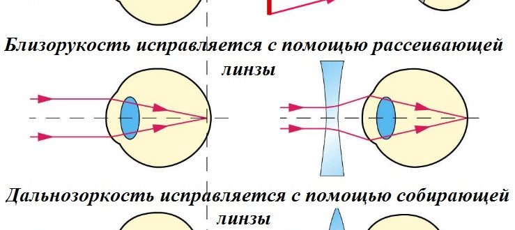 На рисунках изображено несколько линз при близорукости можно применять