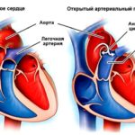 Влияние камней в почках на артериальное давление