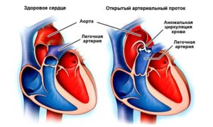 Диаметр легочной артерии меньше диаметра аорты