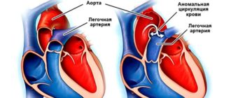 Диаметр легочной артерии меньше диаметра аорты