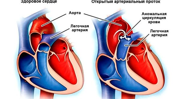 Диаметр легочной артерии меньше диаметра аорты