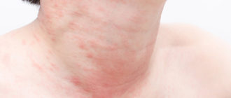 Крапивница не уточненная