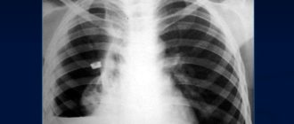 Эмпиема плевры