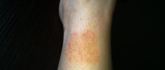 На ноге большое пятно