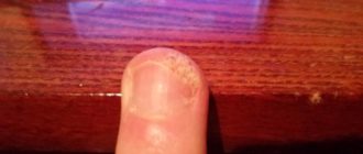На пальце руки возле ногтя грибок или что это