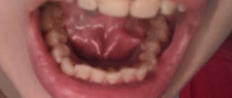 Наросты под языком, боли,