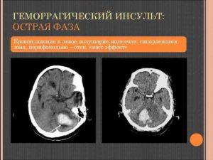 Микрокровоизлияния в левой гемисфере мозжечка