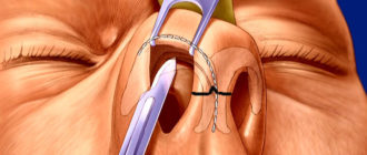 Длительная температура после операции на носовой перегородке