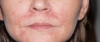 Чем умываться при пероральном дерматите?