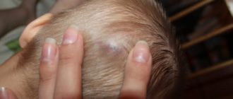 Мягкая шишка на голове