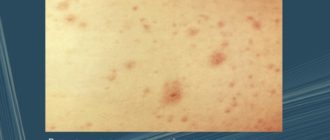 Нагноение папул при ветрянке