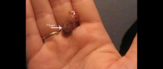 Выделения после самопроизвольного выкидыша на 14 неделе