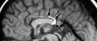 Дисгенезия мозолистого тела, Перикаллезная липома