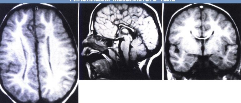 ВПР ЦНС: сужение полости прозрачной перегородки, гипоплазия мозолистого тела