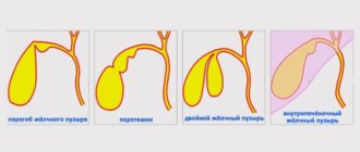 Диарея при загибе желчного