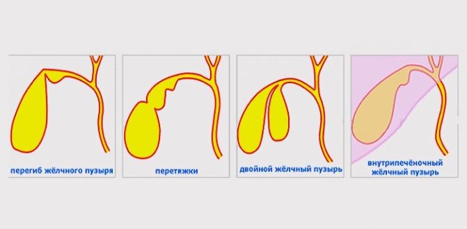 Диарея при загибе желчного