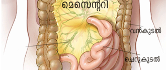 Воспаление Брыжейки