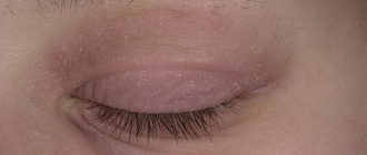 Чёрные веко и шелушение