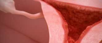 Эндометриоз, мажущие выделения,