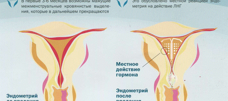 Влияют ли свечи на месячные