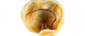 Дермоидная киста