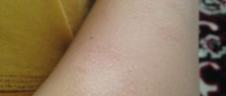 На руке сухое пятно