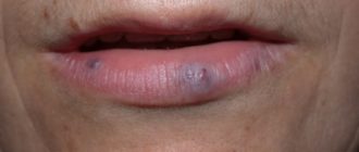 Венка на губе