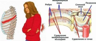 Межреберная невралгия