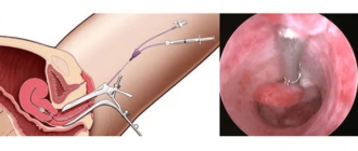 Выделения после удаления матки с шейкой