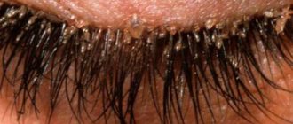 Демодекоз век