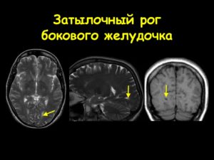 Дистанция затылочных рогов боковых желудочков