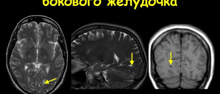 Дистанция затылочных рогов боковых желудочков