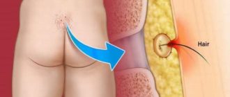 Нарост на копчике