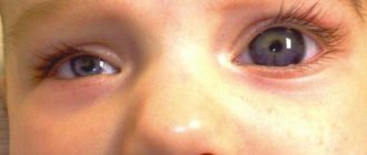 Микрофтальм