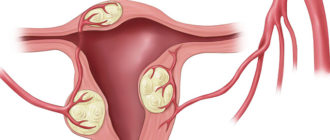 Можно ли пить карсил форте после того как рассосалась миома?