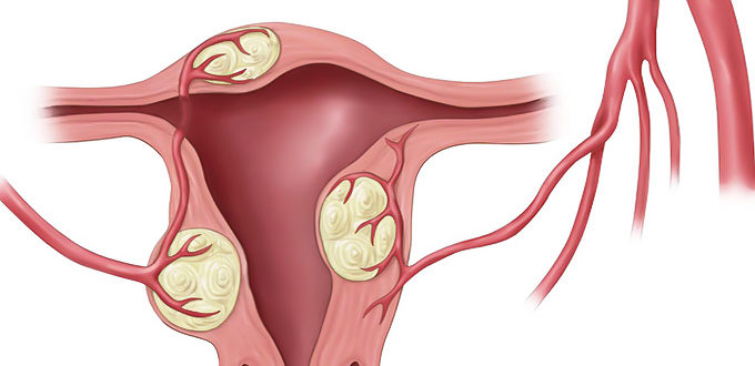 Можно ли пить карсил форте после того как рассосалась миома?