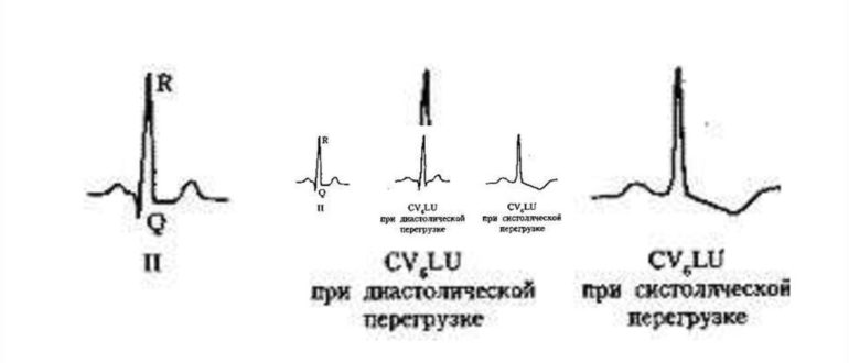 ЭКГ. перегрузка левого желудочка