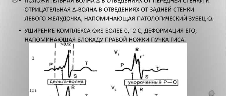 Можно ли заниматься профессионально футболам после операции синдрома wpw