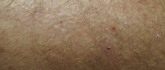 Долго не заживает прыщ