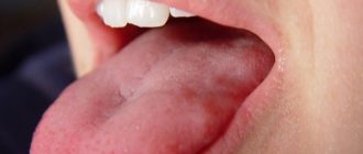 Волдырь - шишка сбоку языка