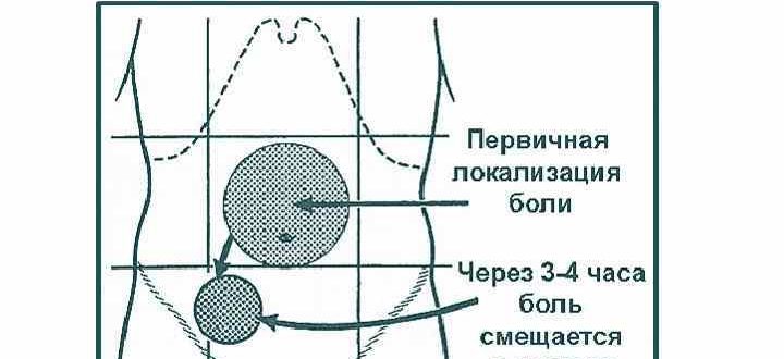 Может ли аппендицит болеть 3 дня? Сильной боли нет она уменьшается