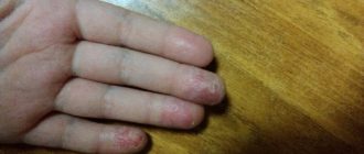 Волдырики на кончиках пальцев у ребёнка