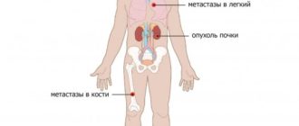 Метастазы в лимфоузлы от почки